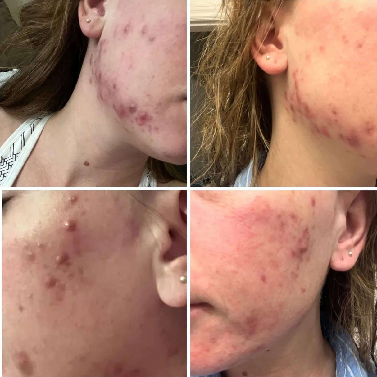 BalanC Toner - Bright Clear Skin | Pregnancy-safe Acne Toner