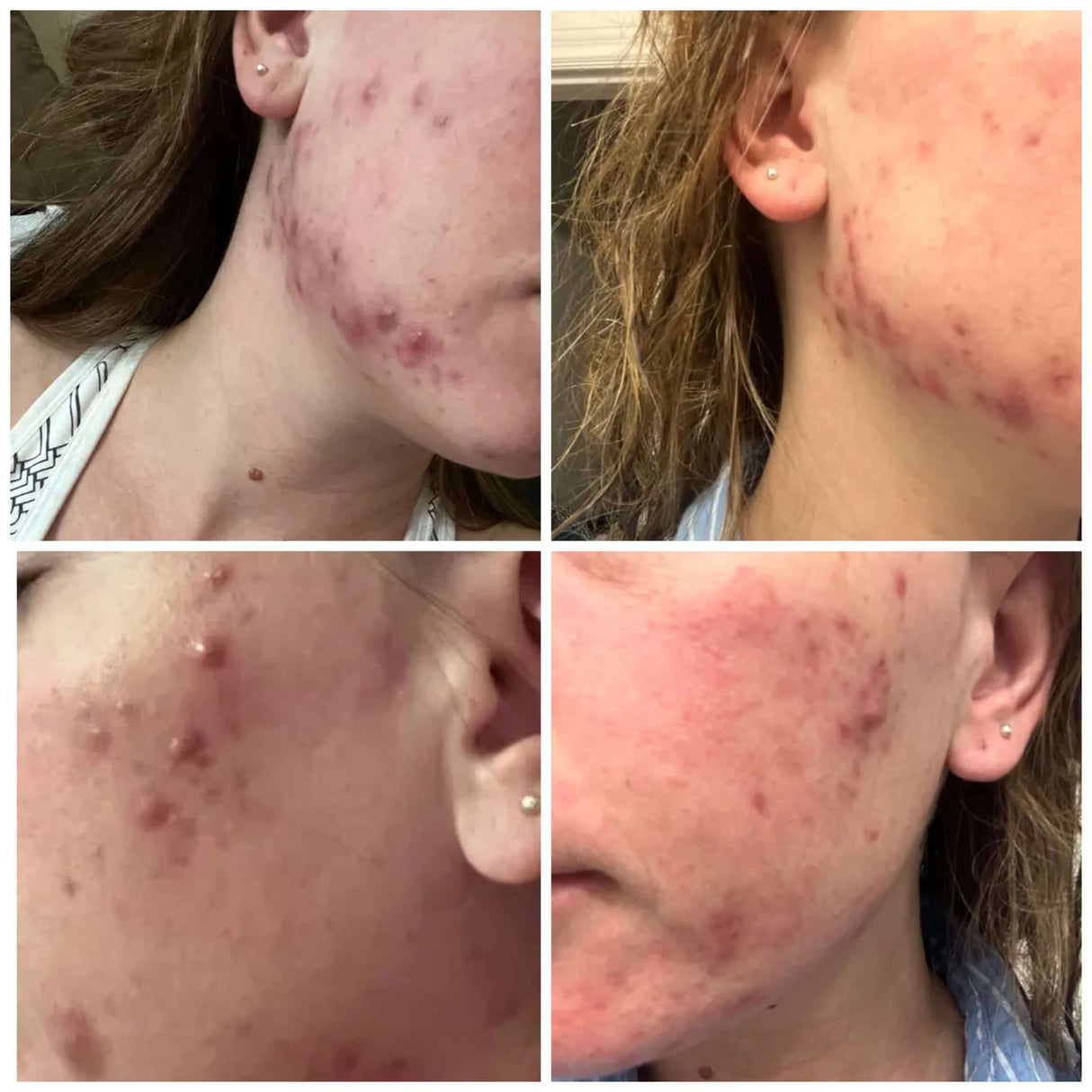 Pregnancy Acne Treatment Kit - HoneyBug 